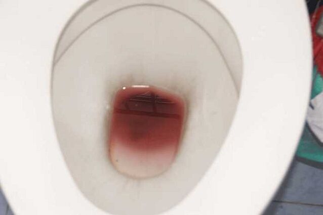 כתמים אצל גברים כאשר הם מתרגשים